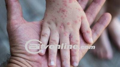 Dinas Kesehatan Sulut Bantah Masuknya Penyakit Cacar Monyet (Mpox) di Wilayahnya